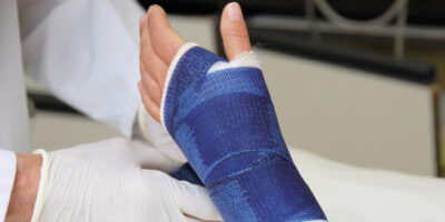 Arm in blauem Gips.